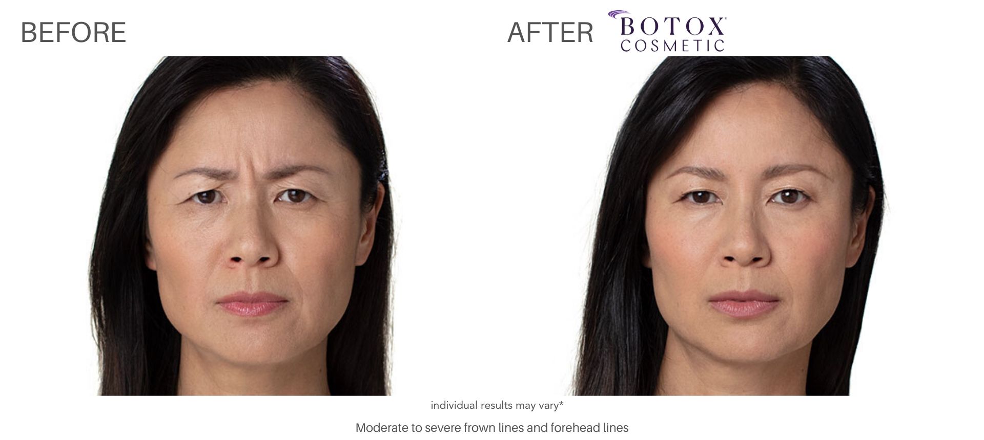 botox before and after treatment frown lines cliffside nj