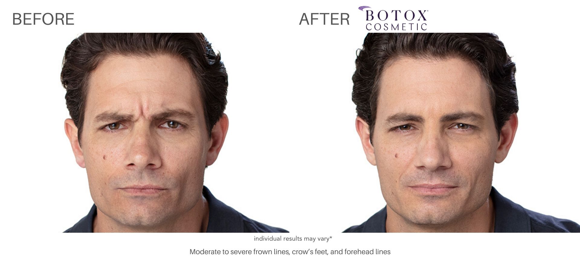 botox before and after treatment crow's feet cliffside nj
