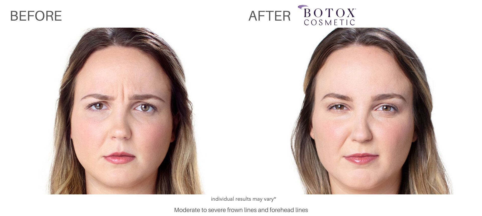 botox before and after treatment forehead lines cliffside nj