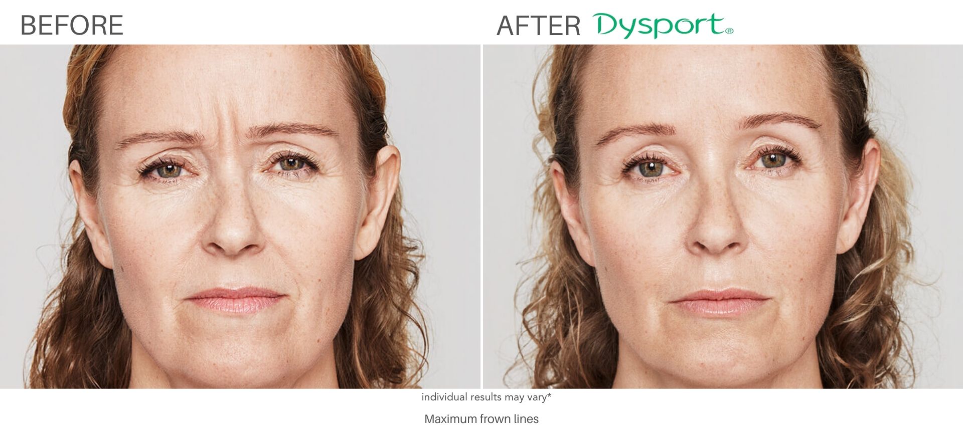 dysport before and after treatment cliffside skin and laser nj