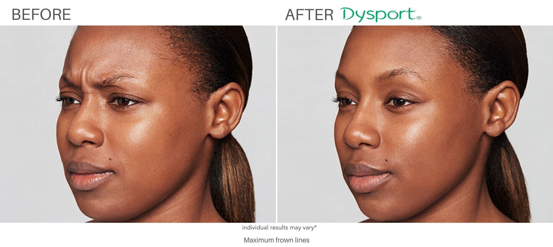dysport before and after treatment cliffside nj