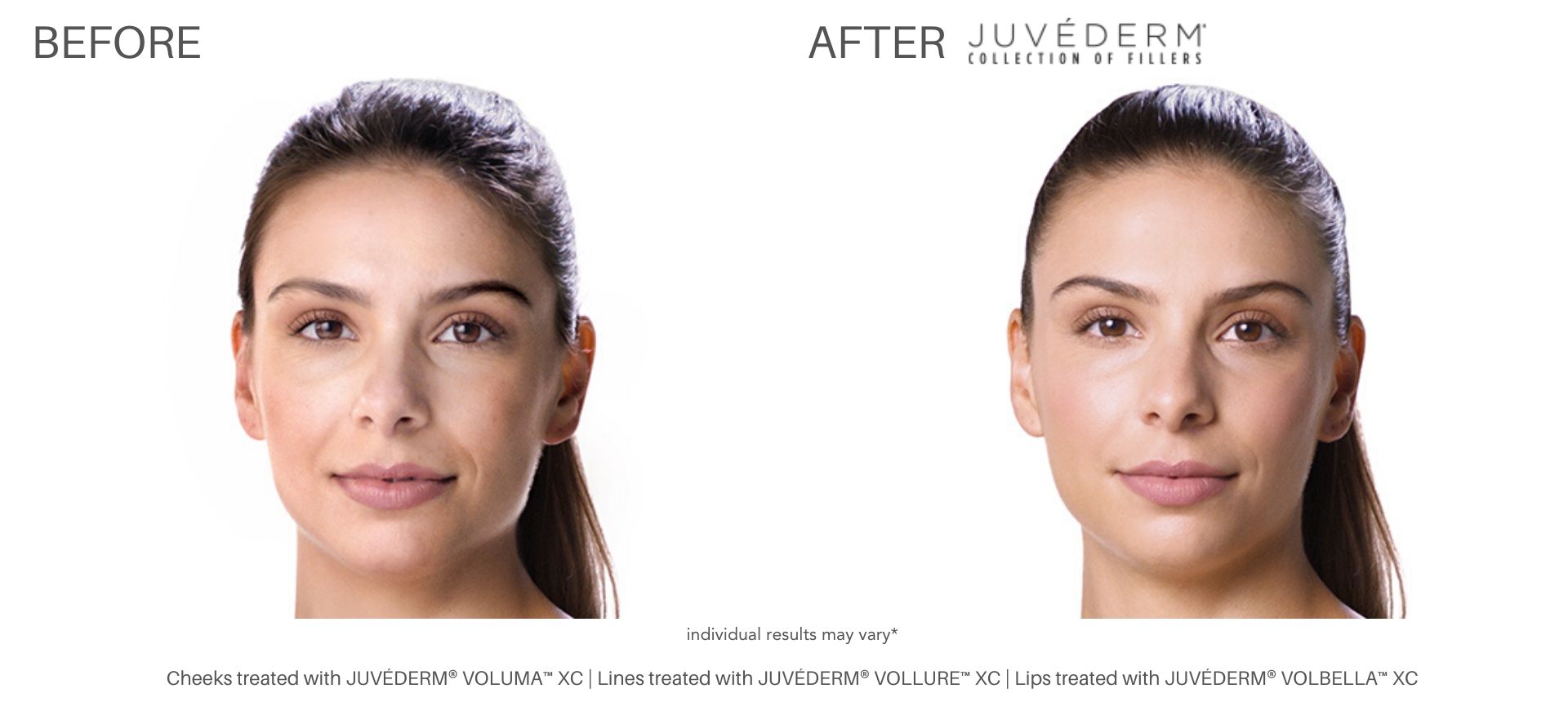 juvederm filler treatment before and after cliffside skin and laser