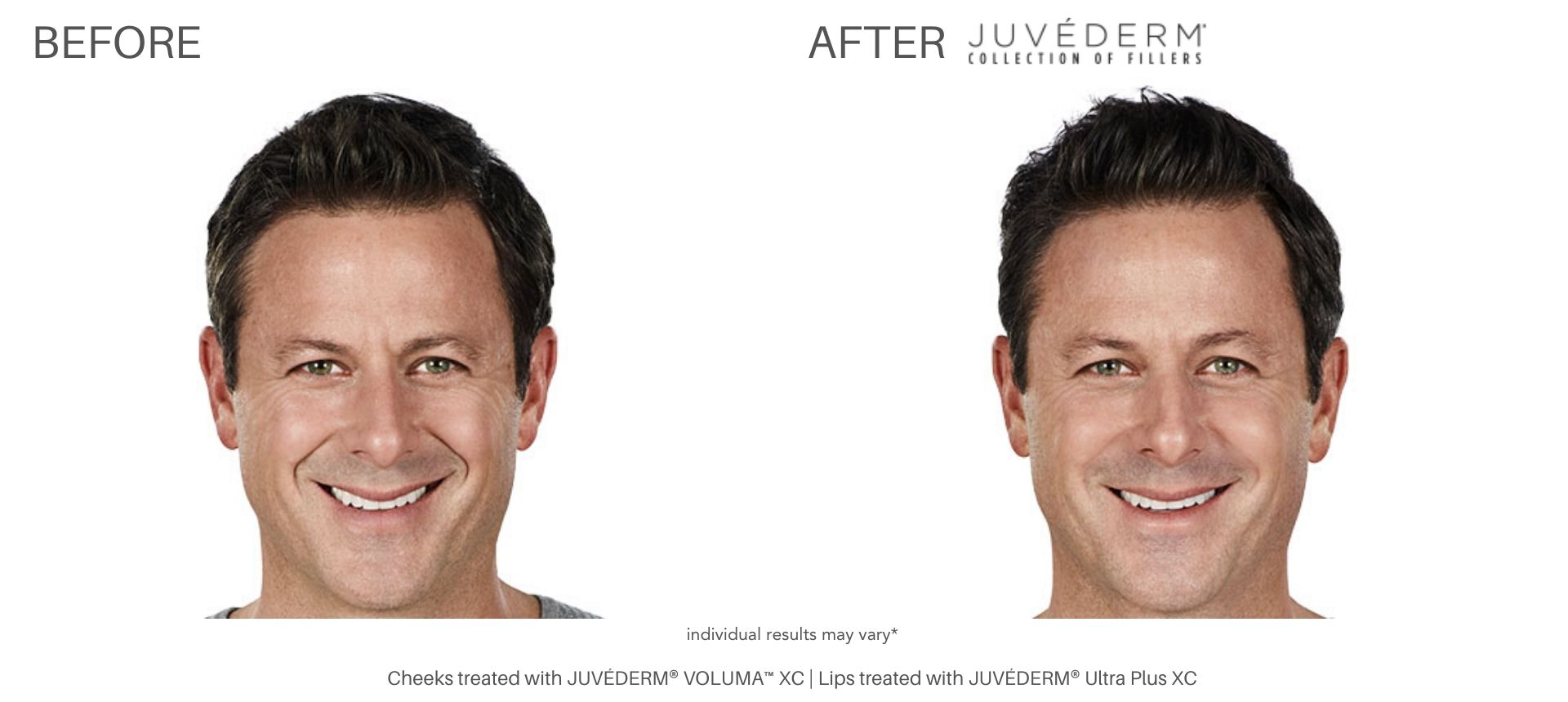 juvederm filler before and after treatment Cliffside Skin & Laser NJ