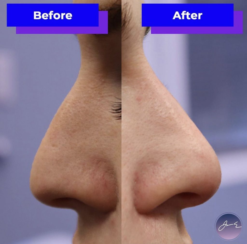 Non Surgical Nose Job Liquid Rhinoplasty Nose Filler