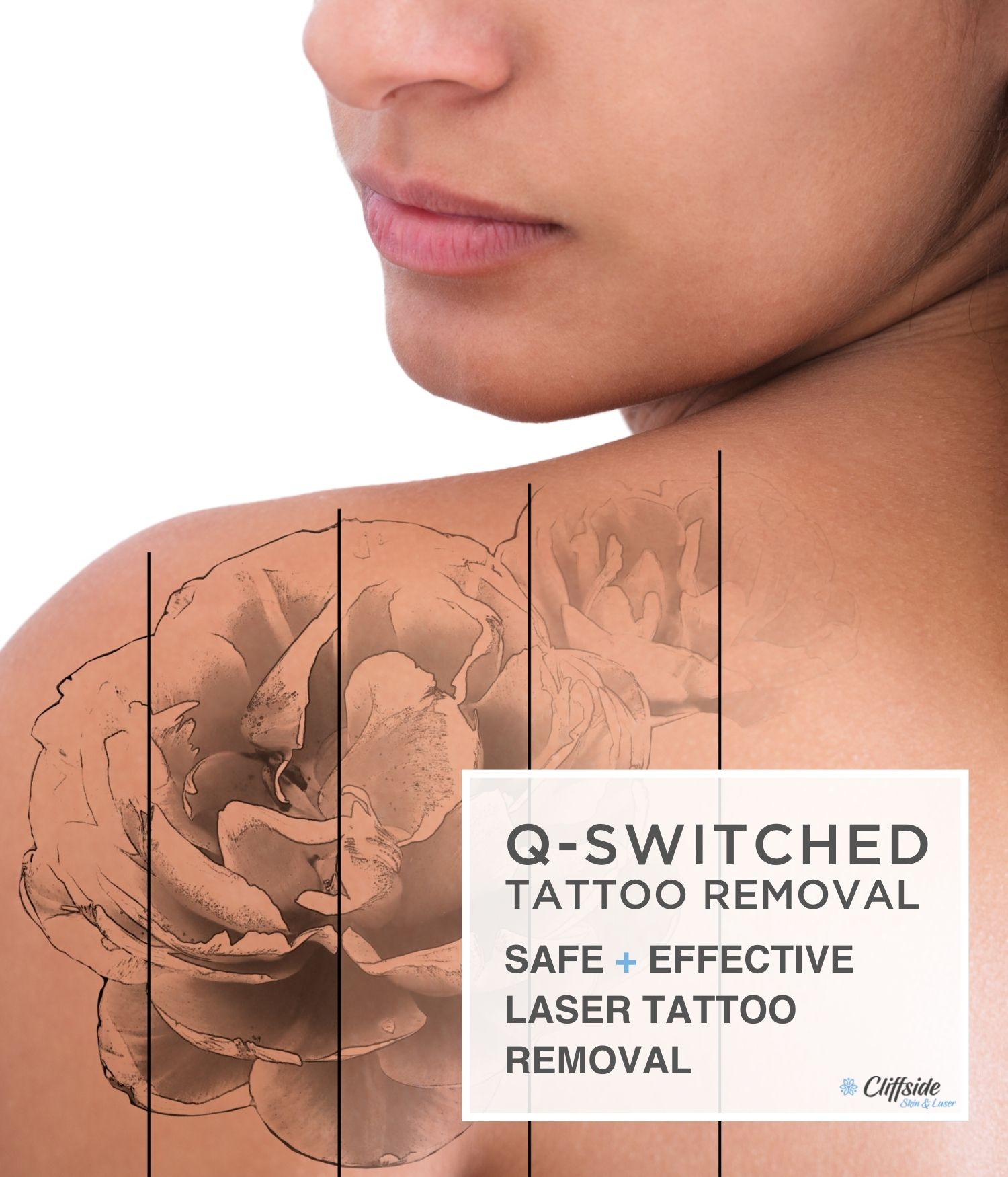Laser tattoo removal on woman's back with Q-Switched