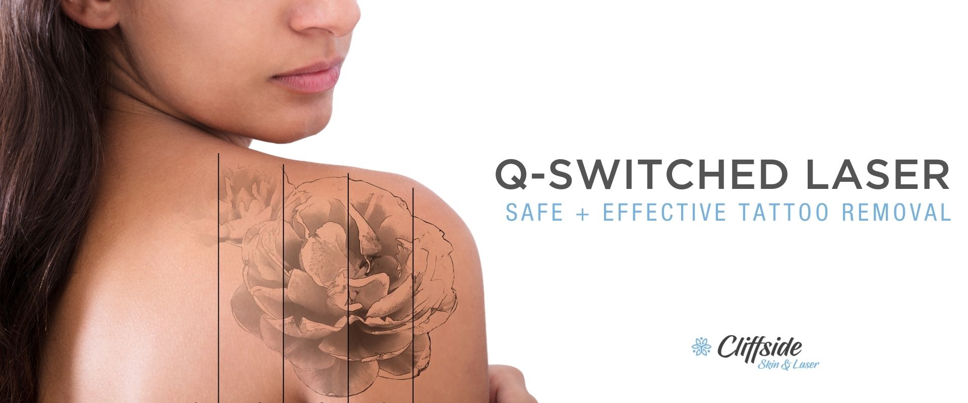 Laser tattoo removal on woman's shoulder with Q-Switched