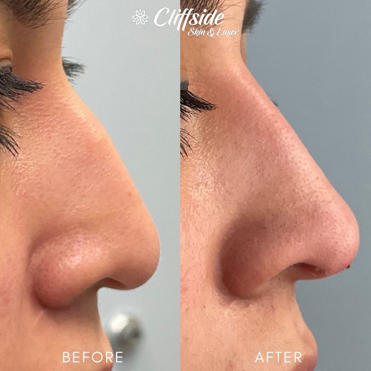 dermal fillers for nose treatment with Dr. Chouake