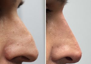 liquid_rhinoplasty_before_and_after_cliffside_skin_and_laser
