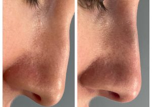 liquid_rhinoplasty_before_and_after_cliffside_skin_and_laser_2